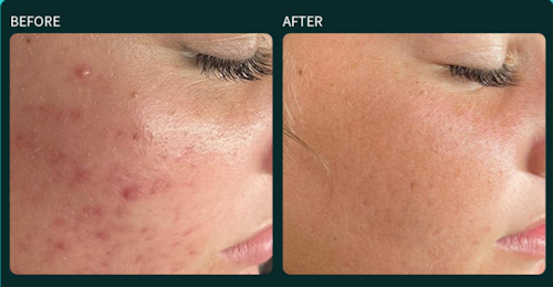 Thulium Laser vorher und nachher