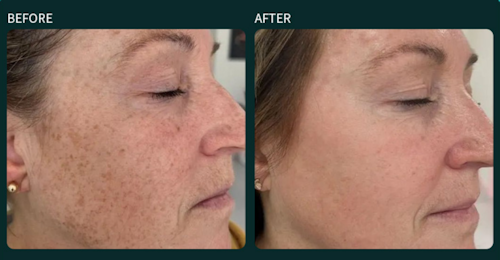 Thulium Laser vorher und nachher